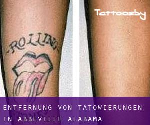 Entfernung von Tätowierungen in Abbeville (Alabama)
