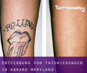 Entfernung von Tätowierungen in Abrams (Maryland)