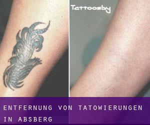 Entfernung von Tätowierungen in Absberg