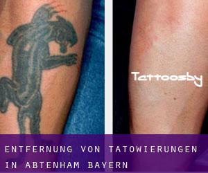 Entfernung von Tätowierungen in Abtenham (Bayern)