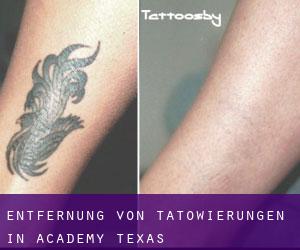 Entfernung von Tätowierungen in Academy (Texas)
