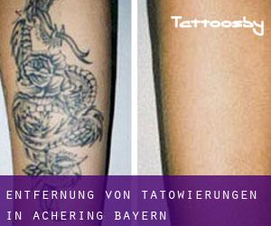 Entfernung von Tätowierungen in Achering (Bayern)