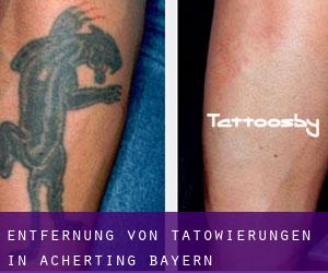 Entfernung von Tätowierungen in Acherting (Bayern)