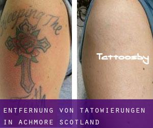 Entfernung von Tätowierungen in Achmore (Scotland)