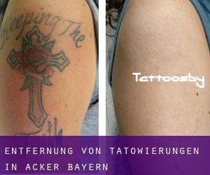 Entfernung von Tätowierungen in Acker (Bayern)