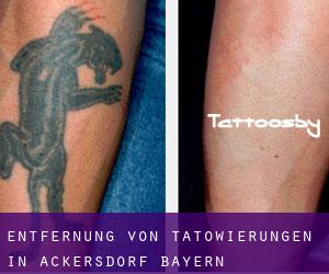 Entfernung von Tätowierungen in Ackersdorf (Bayern)