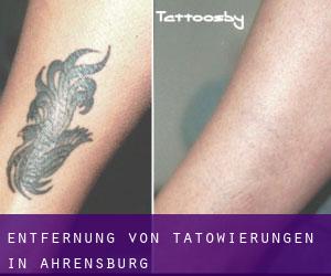 Entfernung von Tätowierungen in Ahrensburg