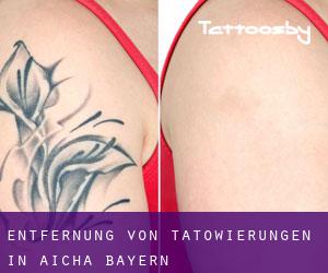Entfernung von Tätowierungen in Aicha (Bayern)