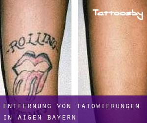 Entfernung von Tätowierungen in Aigen (Bayern)