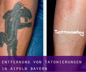 Entfernung von Tätowierungen in Aipoln (Bayern)