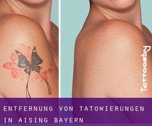 Entfernung von Tätowierungen in Aising (Bayern)