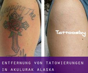 Entfernung von Tätowierungen in Akulurak (Alaska)