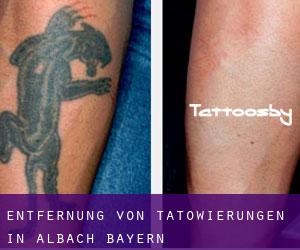 Entfernung von Tätowierungen in Albach (Bayern)