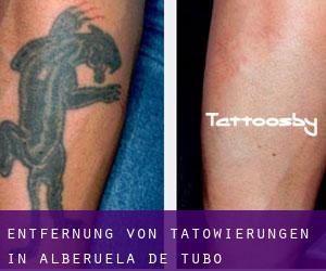 Entfernung von Tätowierungen in Alberuela de Tubo