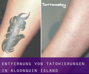 Entfernung von Tätowierungen in Algonquin Island