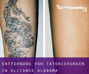 Entfernung von Tätowierungen in Alliance (Alabama)