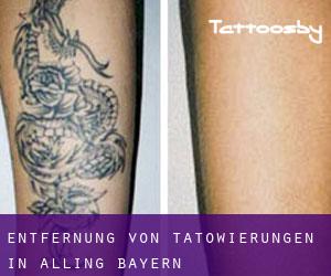 Entfernung von Tätowierungen in Alling (Bayern)