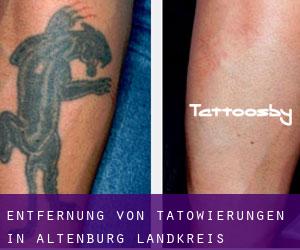 Entfernung von Tätowierungen in Altenburg Landkreis