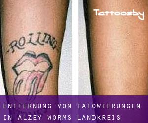 Entfernung von Tätowierungen in Alzey-Worms Landkreis