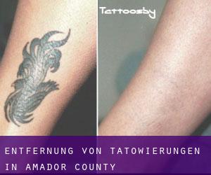 Entfernung von Tätowierungen in Amador County