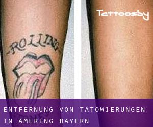 Entfernung von Tätowierungen in Amering (Bayern)