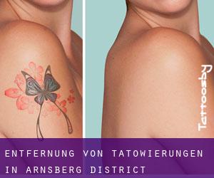 Entfernung von Tätowierungen in Arnsberg District