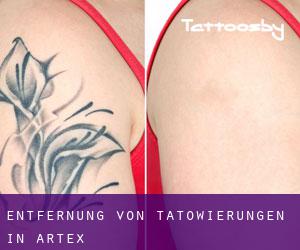 Entfernung von Tätowierungen in Artex