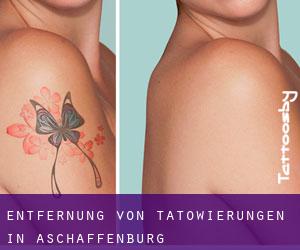 Entfernung von Tätowierungen in Aschaffenburg