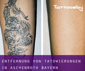Entfernung von Tätowierungen in Aschenroth (Bayern)