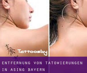 Entfernung von Tätowierungen in Asing (Bayern)