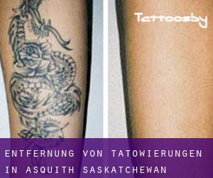 Entfernung von Tätowierungen in Asquith (Saskatchewan)
