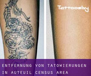 Entfernung von Tätowierungen in Auteuil (census area)