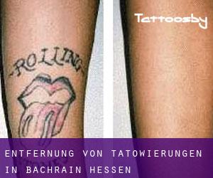 Entfernung von Tätowierungen in Bachrain (Hessen)