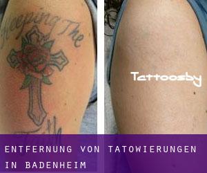 Entfernung von Tätowierungen in Badenheim