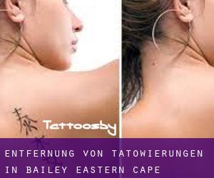 Entfernung von Tätowierungen in Bailey (Eastern Cape)