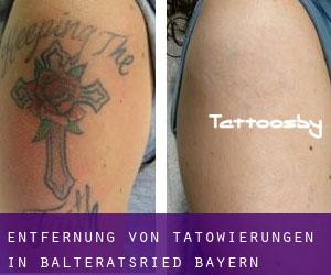Entfernung von Tätowierungen in Balteratsried (Bayern)