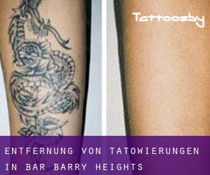 Entfernung von Tätowierungen in Bar-Barry Heights