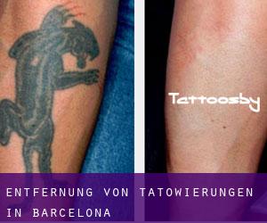 Entfernung von Tätowierungen in Barcelona
