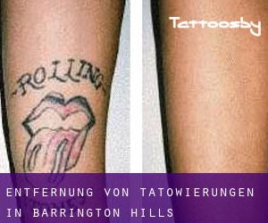 Entfernung von Tätowierungen in Barrington Hills