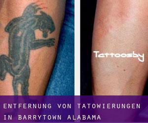 Entfernung von Tätowierungen in Barrytown (Alabama)