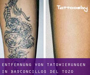 Entfernung von Tätowierungen in Basconcillos del Tozo