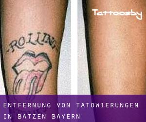 Entfernung von Tätowierungen in Batzen (Bayern)