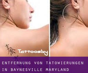Entfernung von Tätowierungen in Baynesville (Maryland)