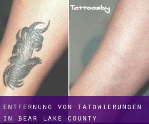Entfernung von Tätowierungen in Bear Lake County