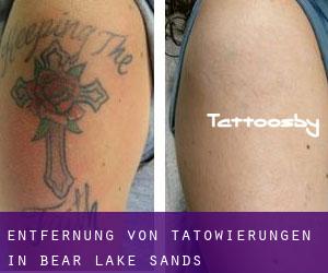 Entfernung von Tätowierungen in Bear Lake Sands