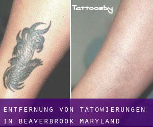 Entfernung von Tätowierungen in Beaverbrook (Maryland)