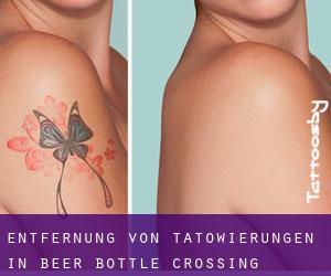 Entfernung von Tätowierungen in Beer Bottle Crossing