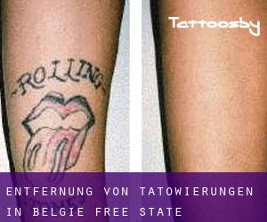 Entfernung von Tätowierungen in België (Free State)