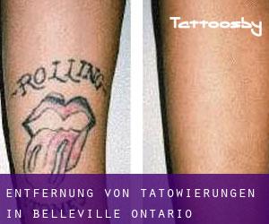 Entfernung von Tätowierungen in Belleville (Ontario)