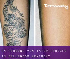 Entfernung von Tätowierungen in Bellewood (Kentucky)